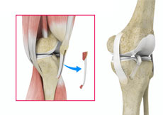 ACL Reconstruction  with Patellar Tendon