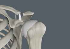 AC Joint Reconstruction