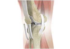 ACL Reconstruction using Allograft