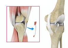 ACL Reconstruction with Patellar Tendon