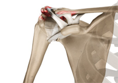 Acromioclavicular (AC) Joint Arthritis