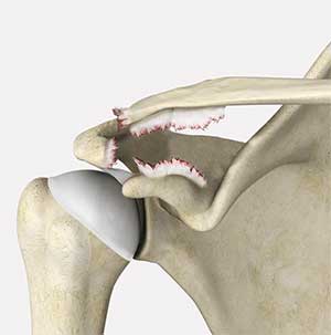 Acromioclavicular (AC) Joint Reconstruction 