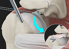 Arthroscopic Superior Capsular Reconstruction (SCR)