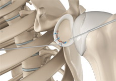 Arthroscopic Bankart Repair