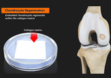 Arthroscopic MACI