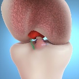 Bridge-Enhanced ACL restoration (BEAR)