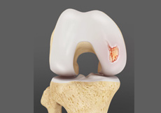 Chondral or Articular Cartilage Defects