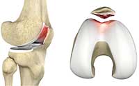 Cartilage Injury of the Patella