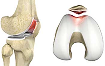 Cartilage Injury of the Patella (chondromalacia patella)