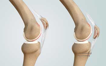 Tibial Tubercle Osteotomy