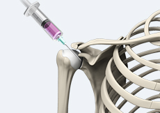 Intraarticular Shoulder Injection