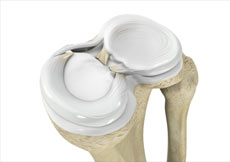 Meniscal Injuries 