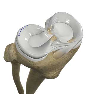 Meniscal repair