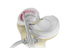 Meniscal Surgery