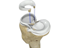 Meniscus Substitution