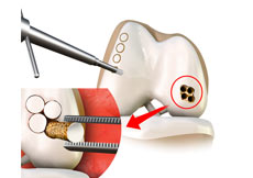 Mosaicplasty