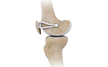 Medial Patellofemoral Ligament Reconstruction