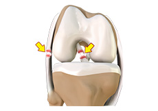 Multiligament Instability