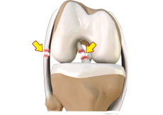  Multiligament Knee Injury