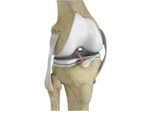 Multiligament Reconstruction of The Knee