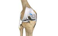 Osteochondritis Dissecans