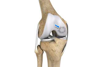 Osteochondritis Dissecans