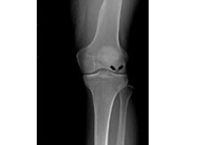 Osteonecrosis of the Knee