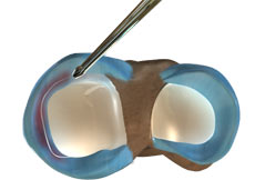 Partial Arthroscopic Meniscectomy