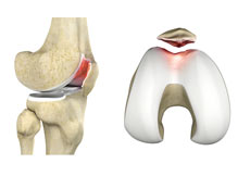 Patellofemoral Surgery