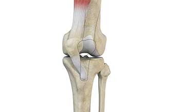 Patella Instability