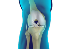 Primary ACL Repair