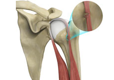 Proximal Biceps Tendon Rupture