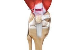 Quadriceps Tendon Tears