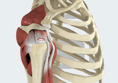 Rotator Cuff Tear