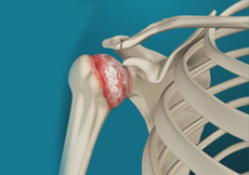 Shoulder Arthritis