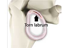 Shoulder Labral Tear