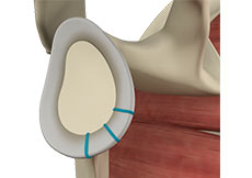 Shoulder Labrum Reconstruction