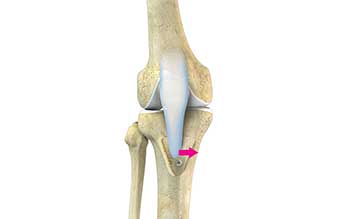 Tibial Tubercle Osteotomy