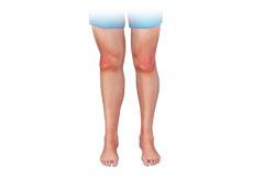 Unstable Knee