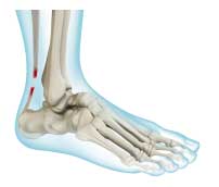 Achilles Tendon Rupture