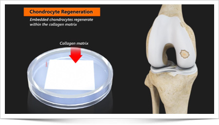 Arthroscopic MACI
